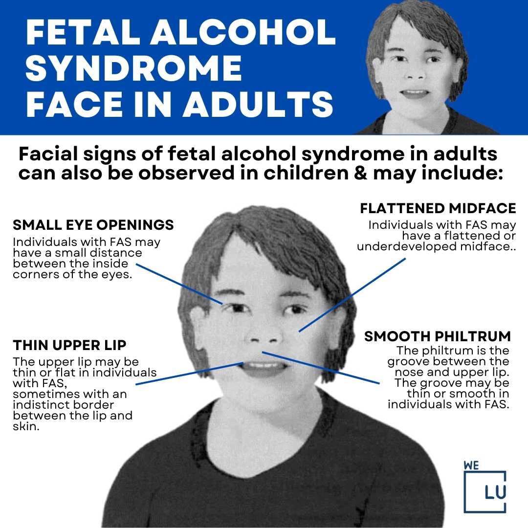 Fetal alcohol syndrome adult, Risk Factors, Alcoholism, Prevention ...